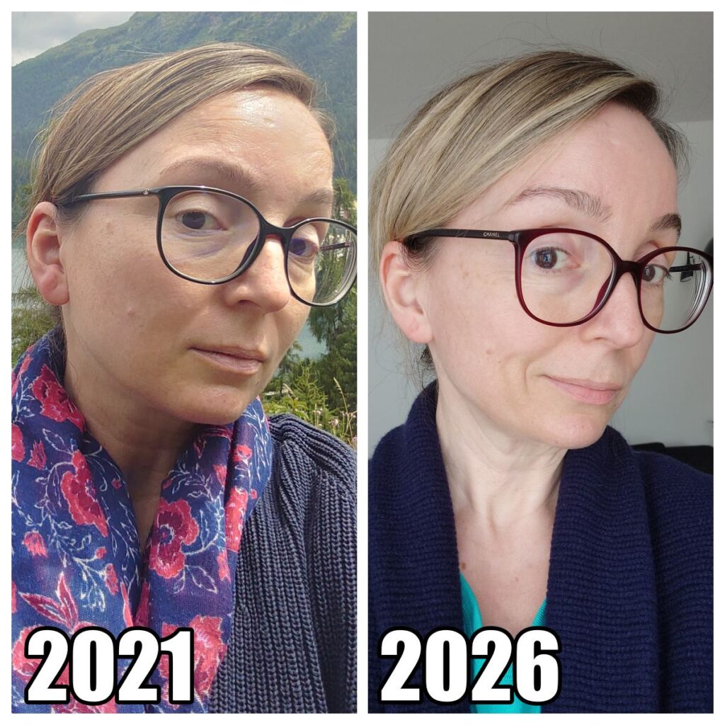 Efekty używania Foreo Bear po 4 latach i utracie 17 kg - porównanie twarzy Ania jestpieknie.pl