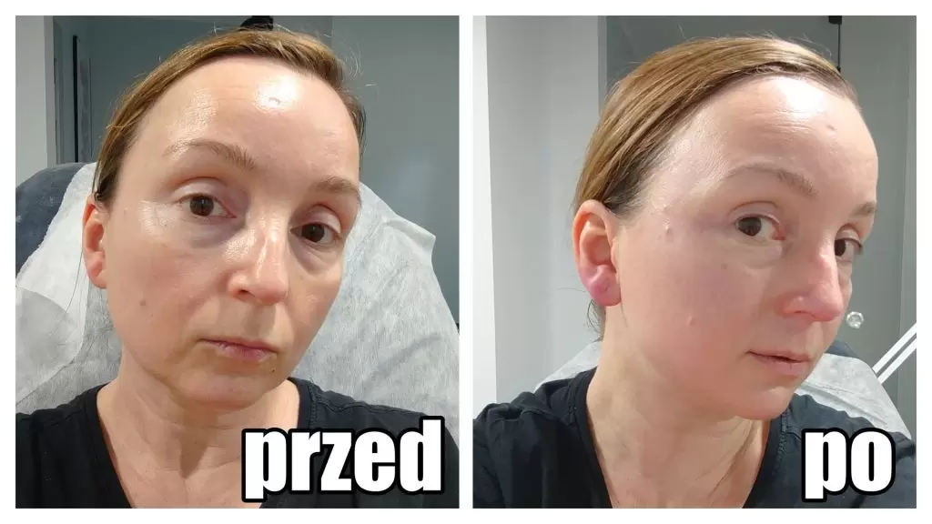 oczyszczanie wodorowe efekty